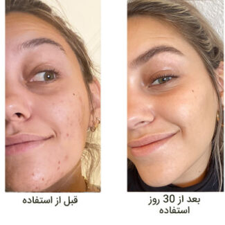 سرم نیاسینامید اوردینری