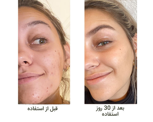 niacinamide the ordinary سرم نیاسینامید اوردینری
